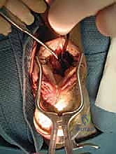 علاج اعتلال وتر أخيل الإدخالي المزمن: دليل شامل لتعزيز الوتر باستخدام وتر FHL مع الأستاذ الدكتور محمد هطيف