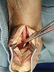 FHL Tendon Augmentation for Insertional Achilles Tendinosis: An Intraoperative Masterclass