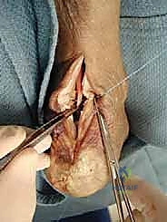 الفتح الجراحي لوتر أخيل