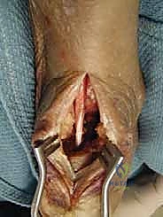 الفسيولوجيا المرضية لاعتلال وتر أخيل