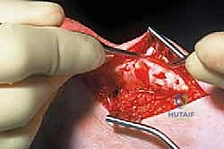 العلاقات التشريحية والأوعية الدموية لوتر أخيل