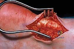 Illustration of med maffulli n - Dr. Mohammed Hutaif