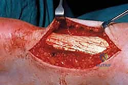 صورة توضح التغيرات التنكسية داخل الوتر