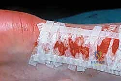 ترميم الوتر والخياطة الجراحية المتقدمة