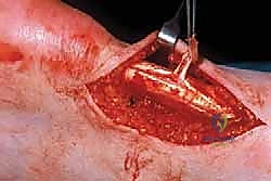 مرحلة التأهيل وارتداء الحذاء الطبي