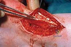 عملية استئصال الأنسجة التالفة من الوتر