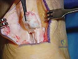 متابعة التئام الجرح في الأسابيع الأولى