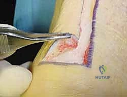 إغلاق الجرح بشكل تجميلي ودقيق