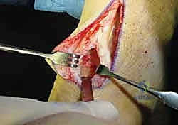 نقل وتر فليكسور هالوسيس لونجوس (FHL) لعلاج التهاب وتر أخيل المزمن: دليل شامل للمرضى
