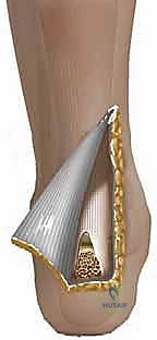 تحديد مسار الشق الجراحي بدقة