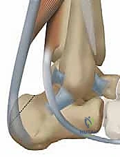 تقوية الوتر الجديد باستخدام أجهزة متخصصة
