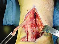 تثبيت الوتر الجديد في عظم الكعب