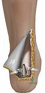 صورة توضيحية لـ نقل وتر فليكسور هالوسيس لونجوس (FHL) لعلاج التهاب وتر أخيل المزمن: دليل شامل للمرضى