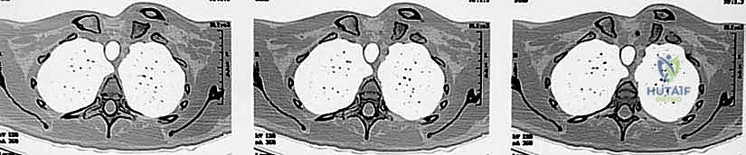 صورة توضيحية لـ خلع المفصل القصي الترقوي: الأسباب، الأعراض، وطرق العلاج وإعادة البناء مع الأستاذ الدكتور محمد هطيف في صنعاء