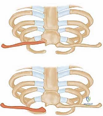 تنظيف المفصل من الأنسجة التالفة