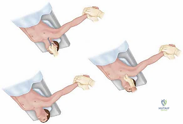 صورة توضيحية لـ خلع المفصل القصي الترقوي: الأسباب، الأعراض، وطرق العلاج وإعادة البناء مع الأستاذ الدكتور محمد هطيف في صنعاء