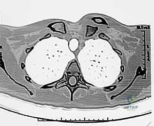 صورة للأشعة المقطعية توضح الخلع بدقة
