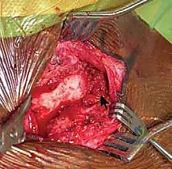 تحضير العظام لاستقبال الرقعة