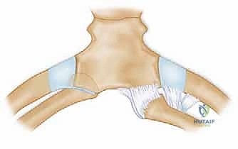 تجهيز الأنفاق لاستقبال الوتر