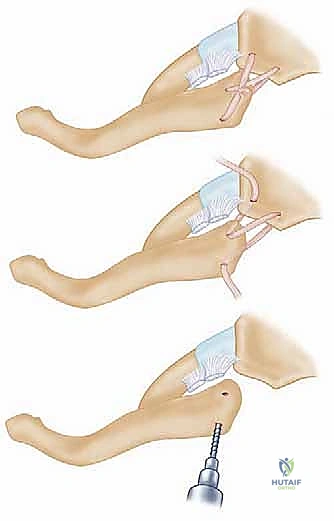 التأكد من سلامة المسار العظمي