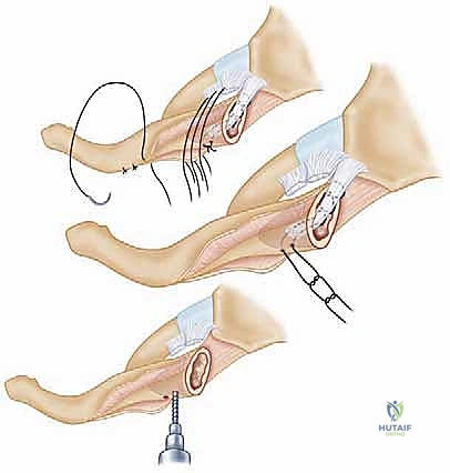 شد الرقعة لضمان الاستقرار المثالي