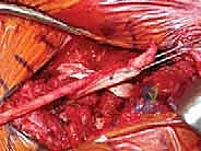 صورة توضيحية لـ خلع المفصل القصي الترقوي: الأسباب، الأعراض، وطرق العلاج وإعادة البناء مع الأستاذ الدكتور محمد هطيف في صنعاء