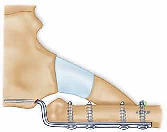 التثبيت النهائي بالخيوط الجراحية المتقدمة