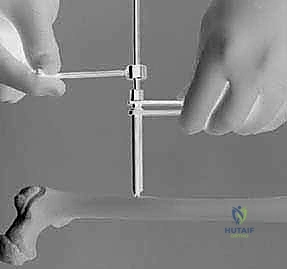 تجهيز المريض لعملية التثبيت الخارجي