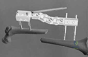 خطوات الرد المغلق للكسر