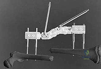 متابعة التئام العظم