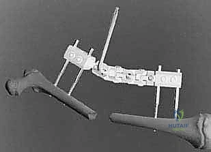 صورة توضيحية لـ كسور عظم الفخذ عند الأطفال التثبيت الخارجي دليل شامل للآباء