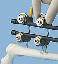 التحقق النهائي من استقامة العظم