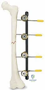 صورة توضيحية لـ كسور عظم الفخذ عند الأطفال التثبيت الخارجي دليل شامل للآباء