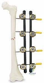 صورة توضيحية لـ كسور عظم الفخذ عند الأطفال التثبيت الخارجي دليل شامل للآباء