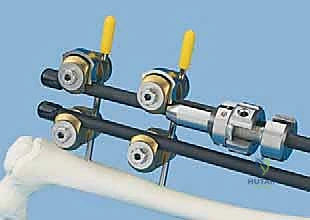 صورة توضيحية لـ كسور عظم الفخذ عند الأطفال التثبيت الخارجي دليل شامل للآباء