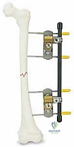صورة توضيحية لـ كسور عظم الفخذ عند الأطفال التثبيت الخارجي دليل شامل للآباء