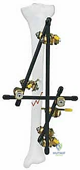 تقييم حالة الكسر من قبل الدكتور محمد هطيف