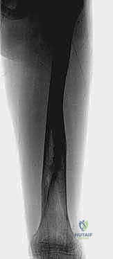 صورة توضيحية لـ كسور عظم الفخذ عند الأطفال التثبيت الخارجي دليل شامل للآباء