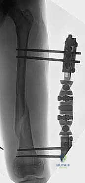 صورة توضيحية لـ كسور عظم الفخذ عند الأطفال التثبيت الخارجي دليل شامل للآباء