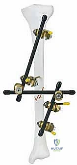 صورة توضيحية لـ كسور عظم الفخذ عند الأطفال التثبيت الخارجي دليل شامل للآباء