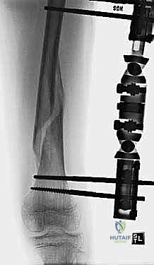 Intraoperative Surgical Step