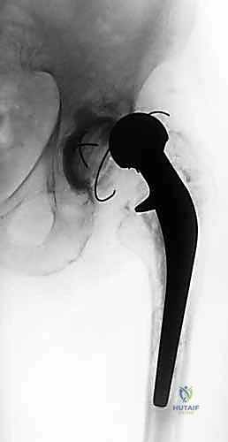 إعادة زرع مفصل الورك على مرحلتين: حل نهائي لعدوى المفاصل الصناعية