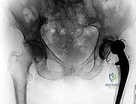 التشريح الدقيق لمفصل الورك الصناعي والعدوى