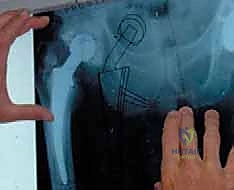 تكوين الغشاء الحيوي على المفاصل الصناعية