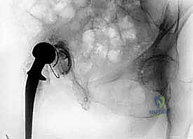 أعراض وعلامات التهاب المفصل الصناعي