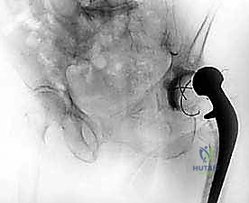 تقييم عوامل الخطر قبل جراحة المراجعة