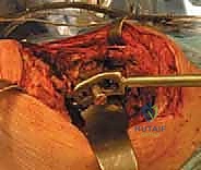 صورة شعاعية للمباعد الأسمنتي داخل الورك