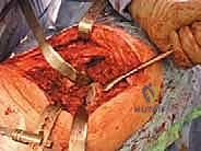 تشكيل ووضع المباعد الأسمنتي المحمل بالمضادات