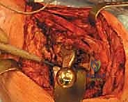 التخطيط الجراحي لعملية المرحلتين