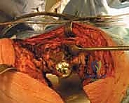 مقارنة الخيارات الجراحية لعلاج العدوى